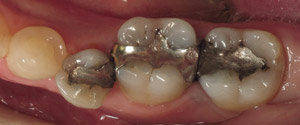 Closeup of teeth before same day dental crowns