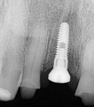 X ray of tooth with dental implant