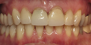 Closeup of smile before cosmetic enhancement with new dental crowns