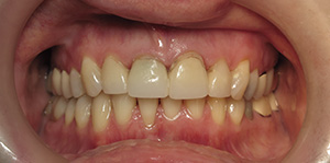 Closeup smile before new dental crowns