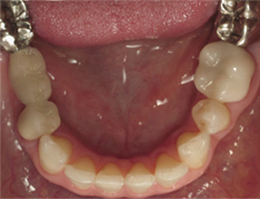 Closeup of bottom teeth after replacing old fillings
