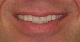 Smile after all ceramic dental crowns and veneers