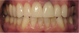 Closeup of smile after all ceramic dental crowns and veneers