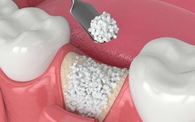 Animated smile during bone grafting procedure