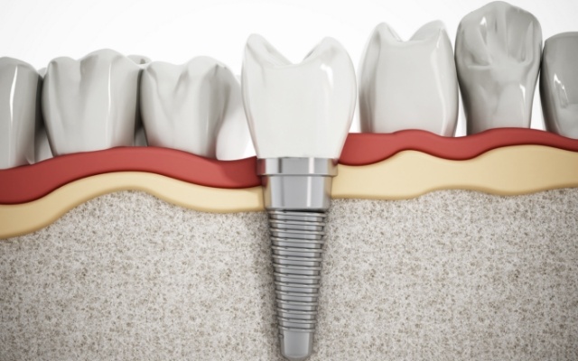 Animated smile with dental implant after sinus lift