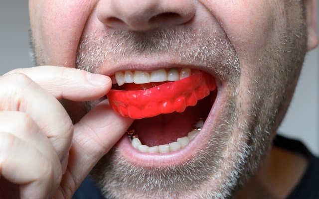 Closeup of patient placing a custom mouthguard