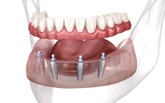 A digital model of implant dentures 