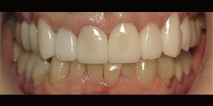 Closeup of smile after dental implant dental crown and veneer treatment