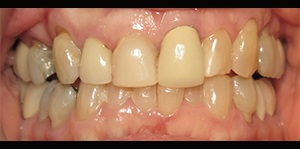 Closeup of smile before dental implant dental crown and veneer treatment
