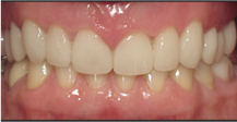 Front of smile after full mouth restoration