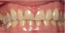 Front of smile before full mouth restoration