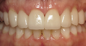 Closeup of smile after veneers