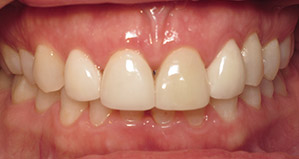 Closeup of smile before veneers