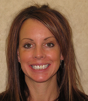 Woman smiling before veneers