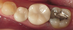 Closeup of teeth after same day dental crowns