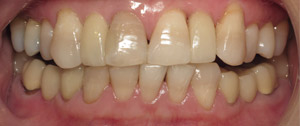 Closeup of smile after dental implant tooth replacement