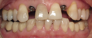 Closeup fo smile before dental implant tooth replacement