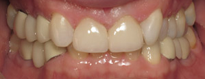 Closeup of smile after closing gap between front teeth