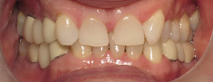 Closeup of smile with gab between front teeth