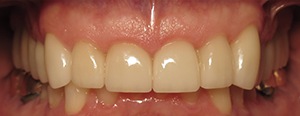 Closeup of smile after smile makeover with dental crowns