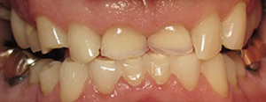 Closeup of smile before smile makeover with dental crowns