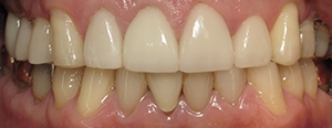 Closeup of smile after tooth replacement with dental implant