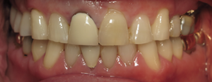 Closeup of smile before replacing damaged tooth with dental implant