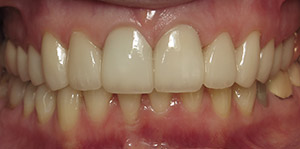 Closeup of smile after cosmetic enhancement with new dental crowns
