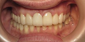 Closeup of smile after new dental crowns