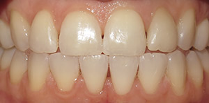 Closeup of smile after clear braces and teeth whitening