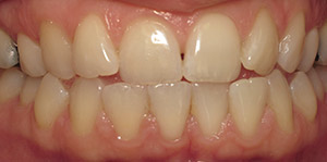 Closeup of smile before clear braces and teeth whitening