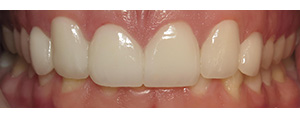 Closeup of smile after dental crowns and veneers