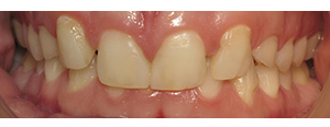 Closeup of smile before dental crowns and veneers