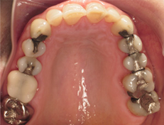 Closeup of top teeth before replacing old fillings