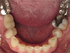 Closeup of bottom teeth before replacing old fillings