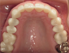 Closeup of top teeth after replacing old fillings