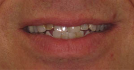 Smile before all ceramic dental crowns and veneers