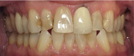 Closeup of smile before all ceramic dental crowns and veneers