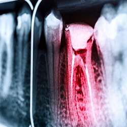 a patient xray 