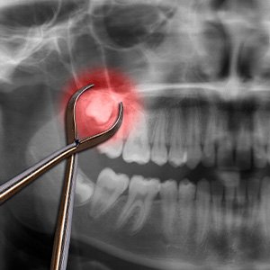 Dental X-ray of impacted wisdom teeth