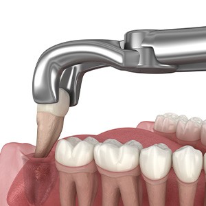 A tooth being extracted