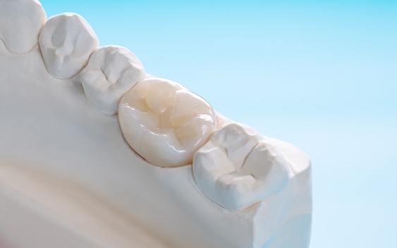 A single dental crown on a mouth mold