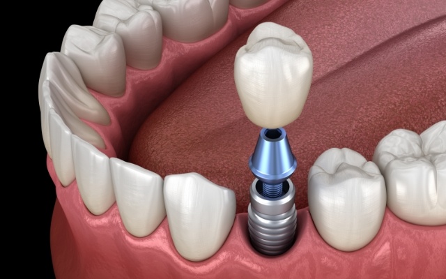 Animated smile during dental implant placement