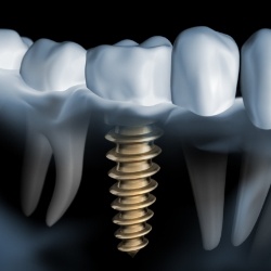Animated smile showing dental implant osseointegration