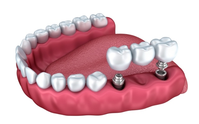 Animated smile during dental implant supported fixed bridge placement