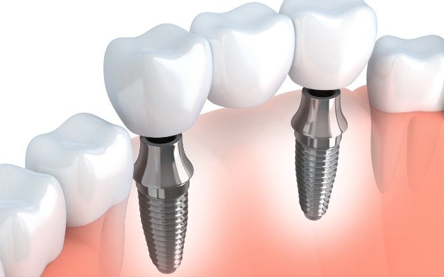 Animated smile with fixed bridge