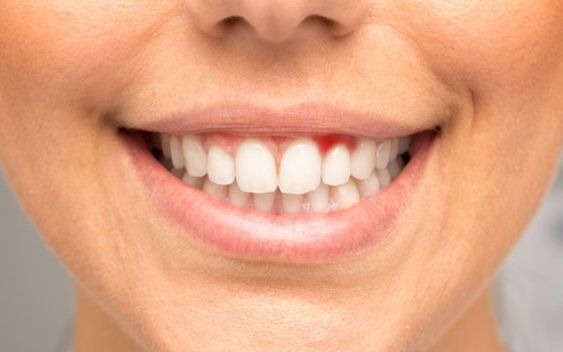 Up-close view of red and swollen gum tissue