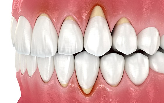 Digital view of gum recession