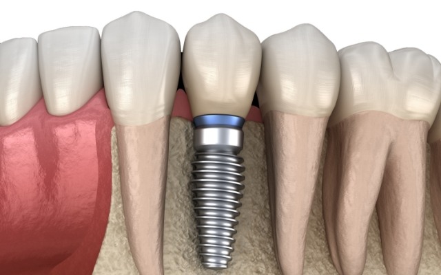 Animated smile with dental implant supported dental crown