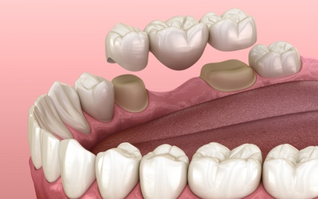 Animated smile during fixed bridge placement